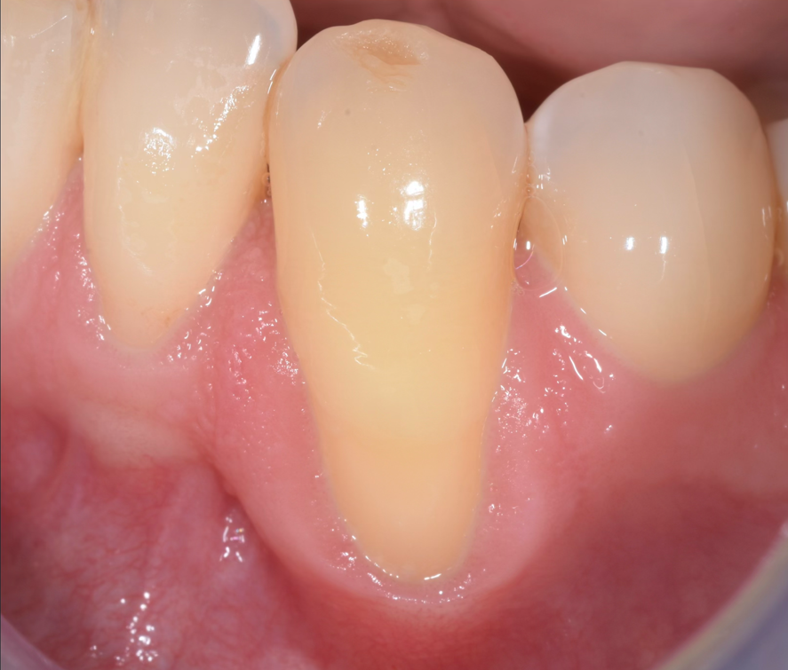 Treatment of Gingival Recession